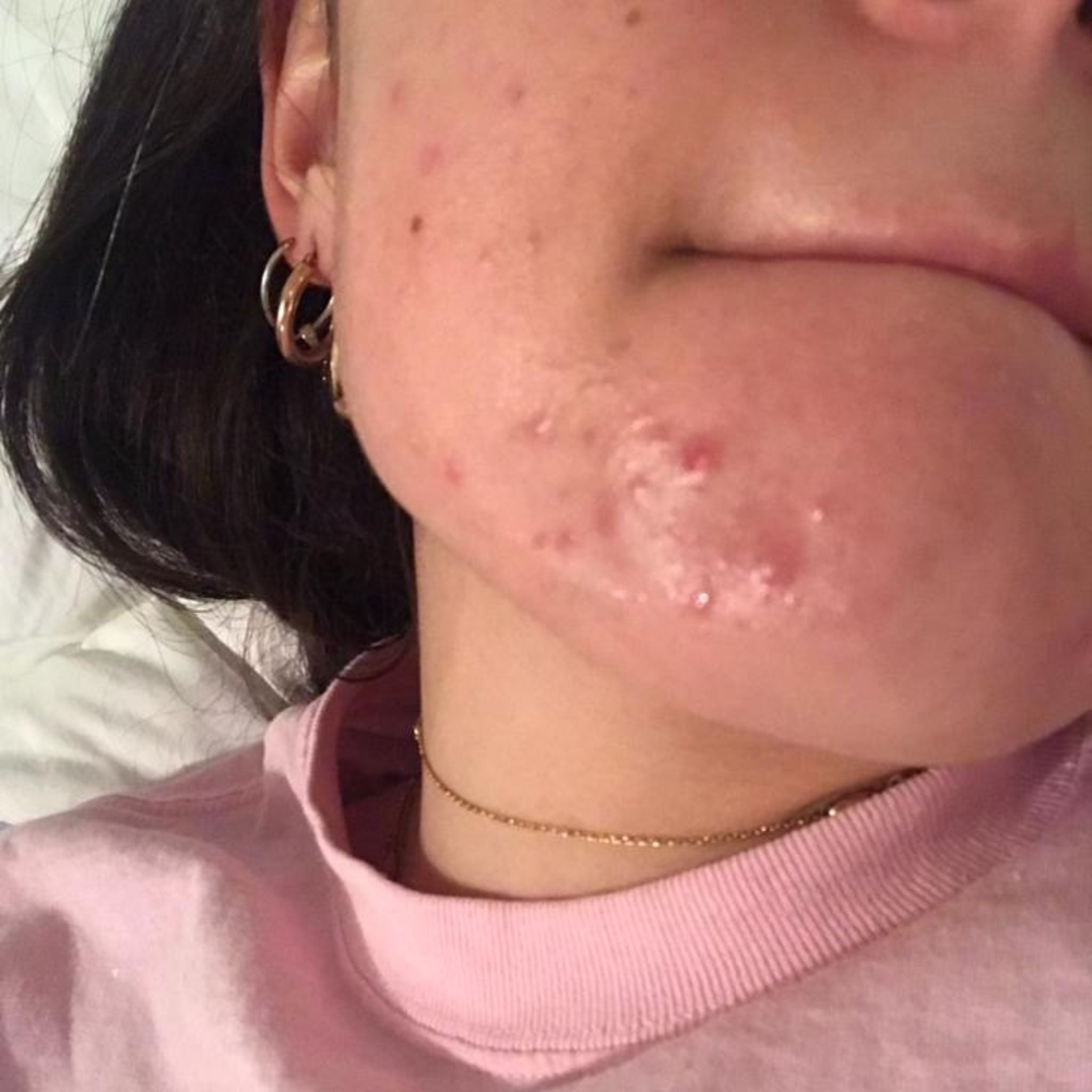 close up image of woman with jawline acne
