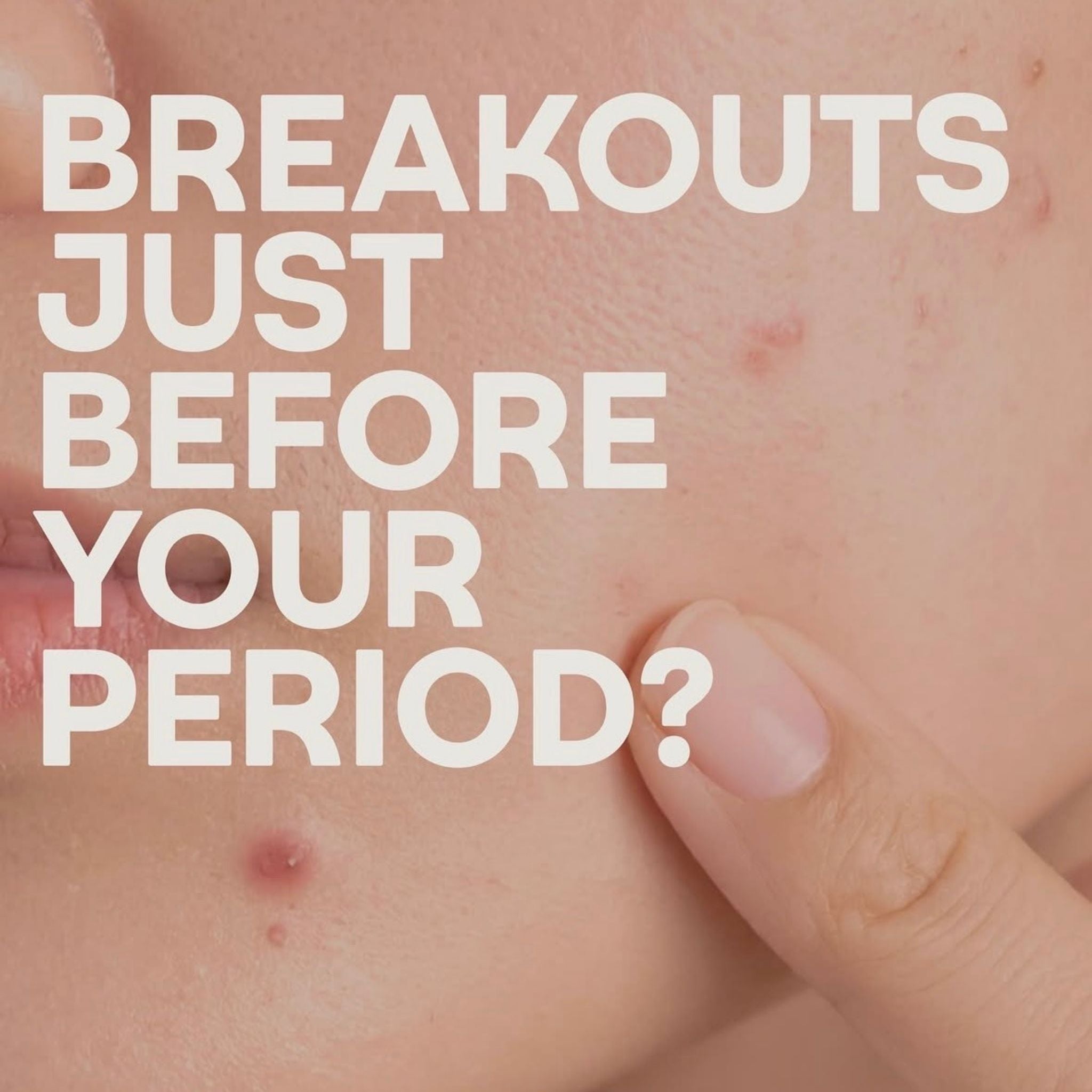 Woman with visible breakout and overlay text 'breakouts just before your period?'