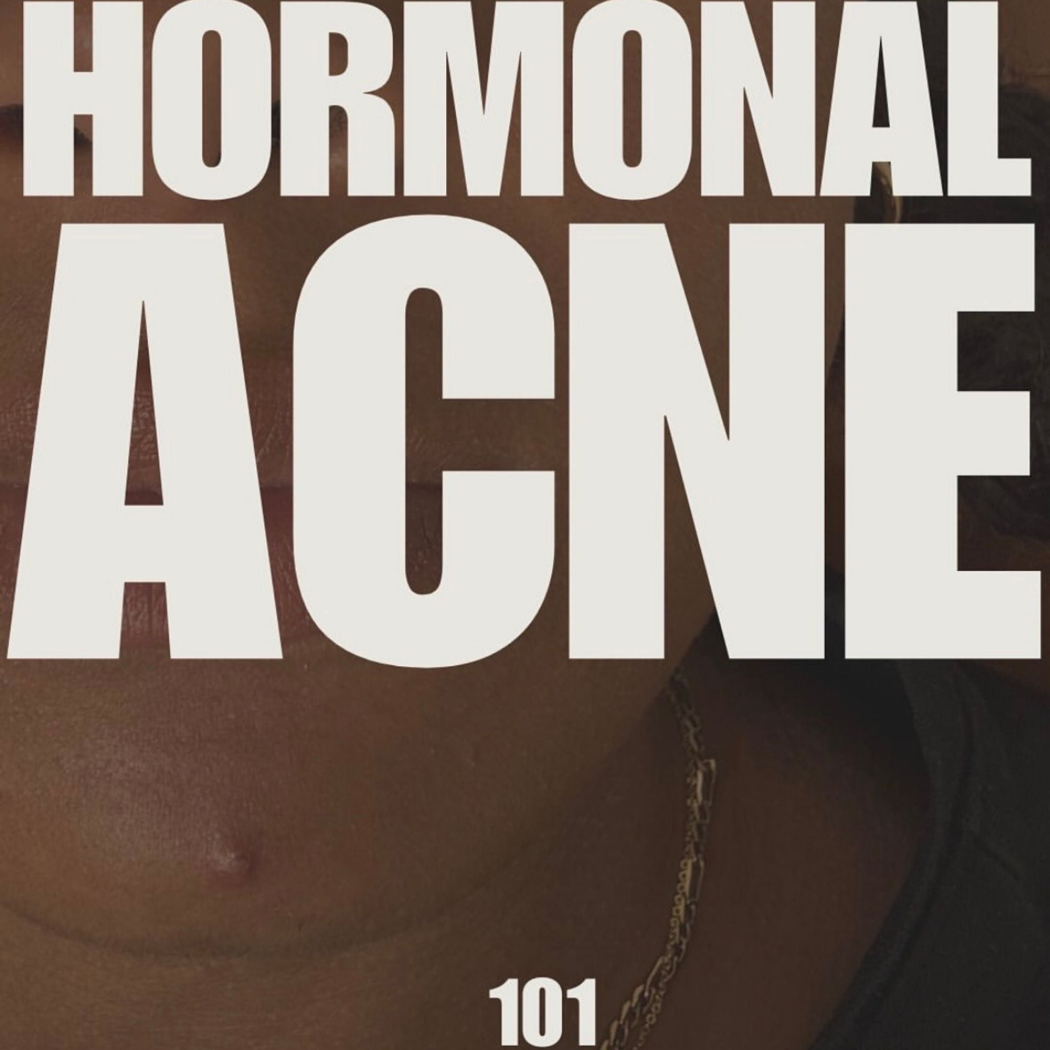 Close up image of face with spot on chin and overlay text 'Hormonal acne 101'