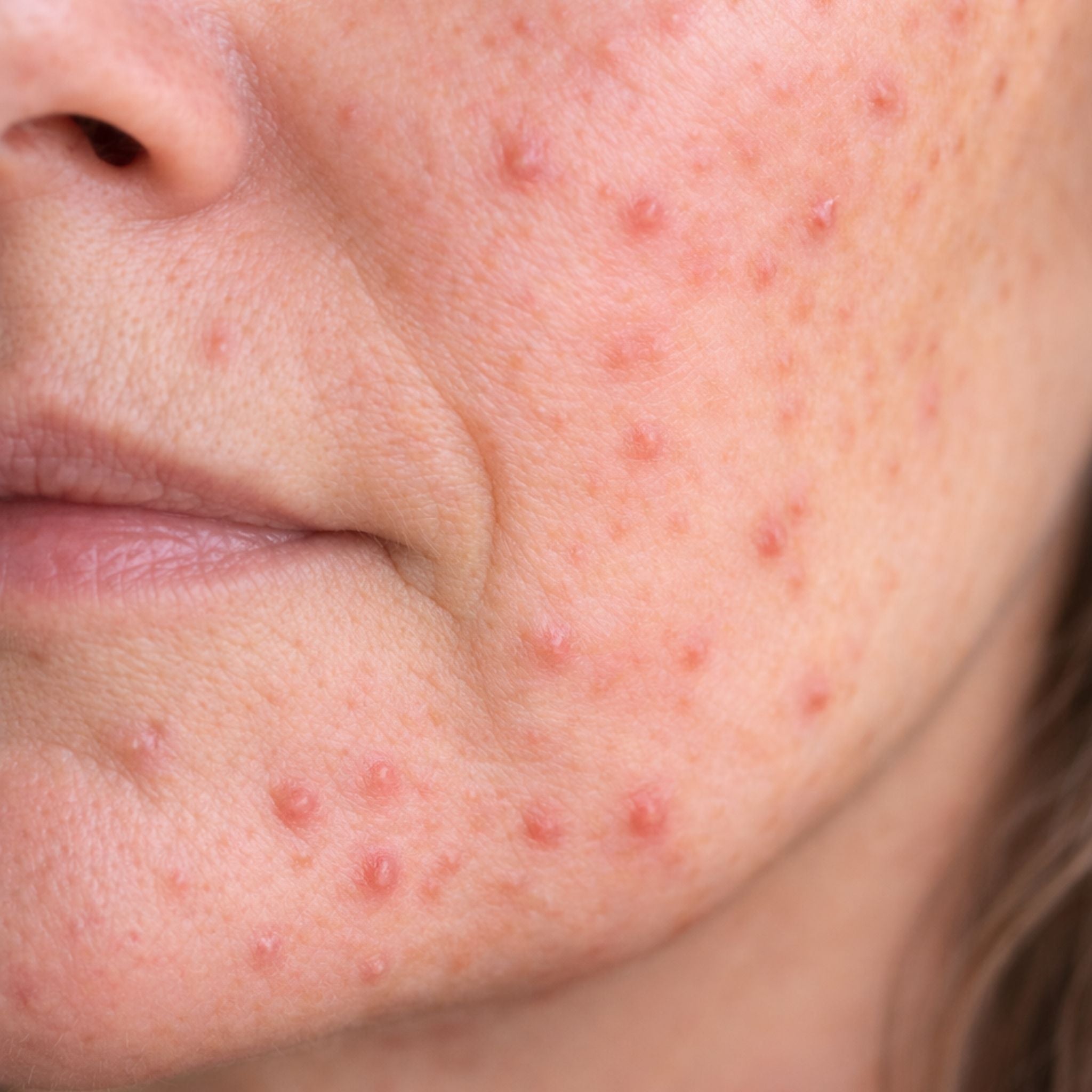 Mature skin with visible acne
